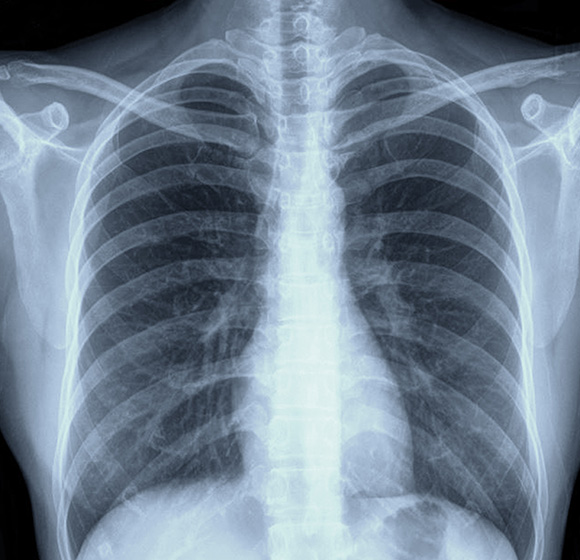 Chest X-ray showing detailed lung and rib structures.