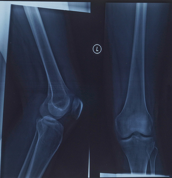 Left and right knee X-ray images showing bones and joints in detail.