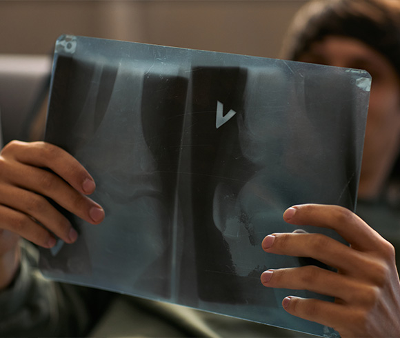 A person holding an X-ray film showing a knee joint image.
