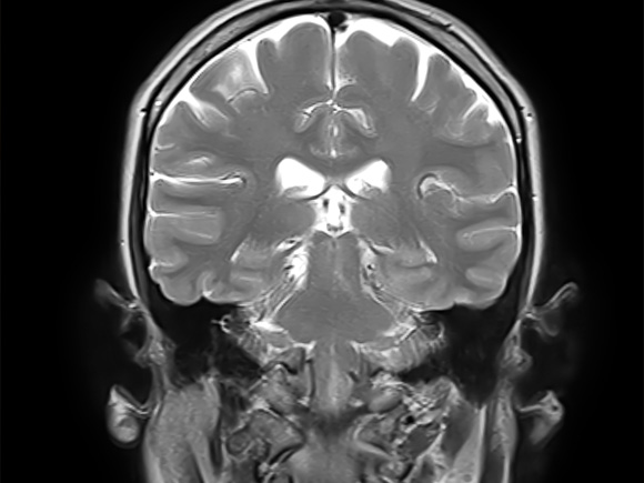 Coronal MRI scan of the brain showing detailed anatomical structures.